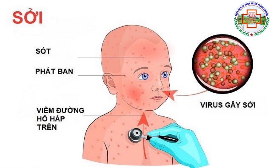 KHUYẾN CÁO PHÒNG CHỐNG BỆNH SỞI
