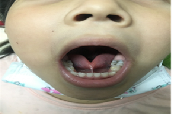 CẮT PHANH LƯỠI – CAN THIỆP TỐI THIỂU, LỢI ÍCH TỐI ĐA CHO SỰ PHÁT TRIỂN CỦA TRẺ