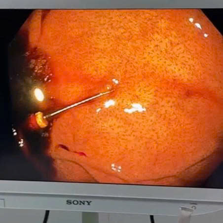 NỘI SOI GẮP DỊ VẬT ĐƯỜNG TIÊU HÓA THÀNH CÔNG TẠI BỆNH VIỆN ĐA KHOA TÂN YÊN